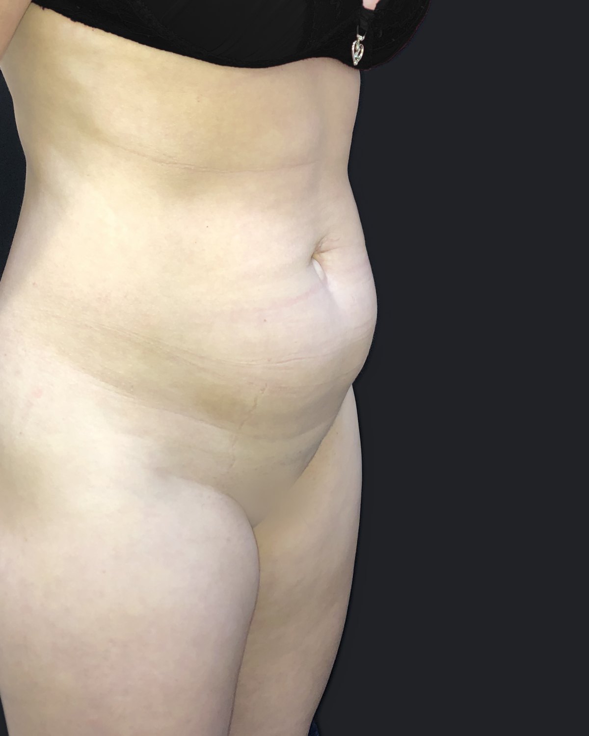 Antes — Abdominoplastia com lipoaspiração