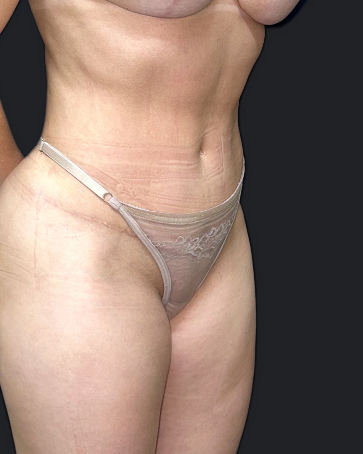 Depois — Abdominoplastia com lipoaspiração