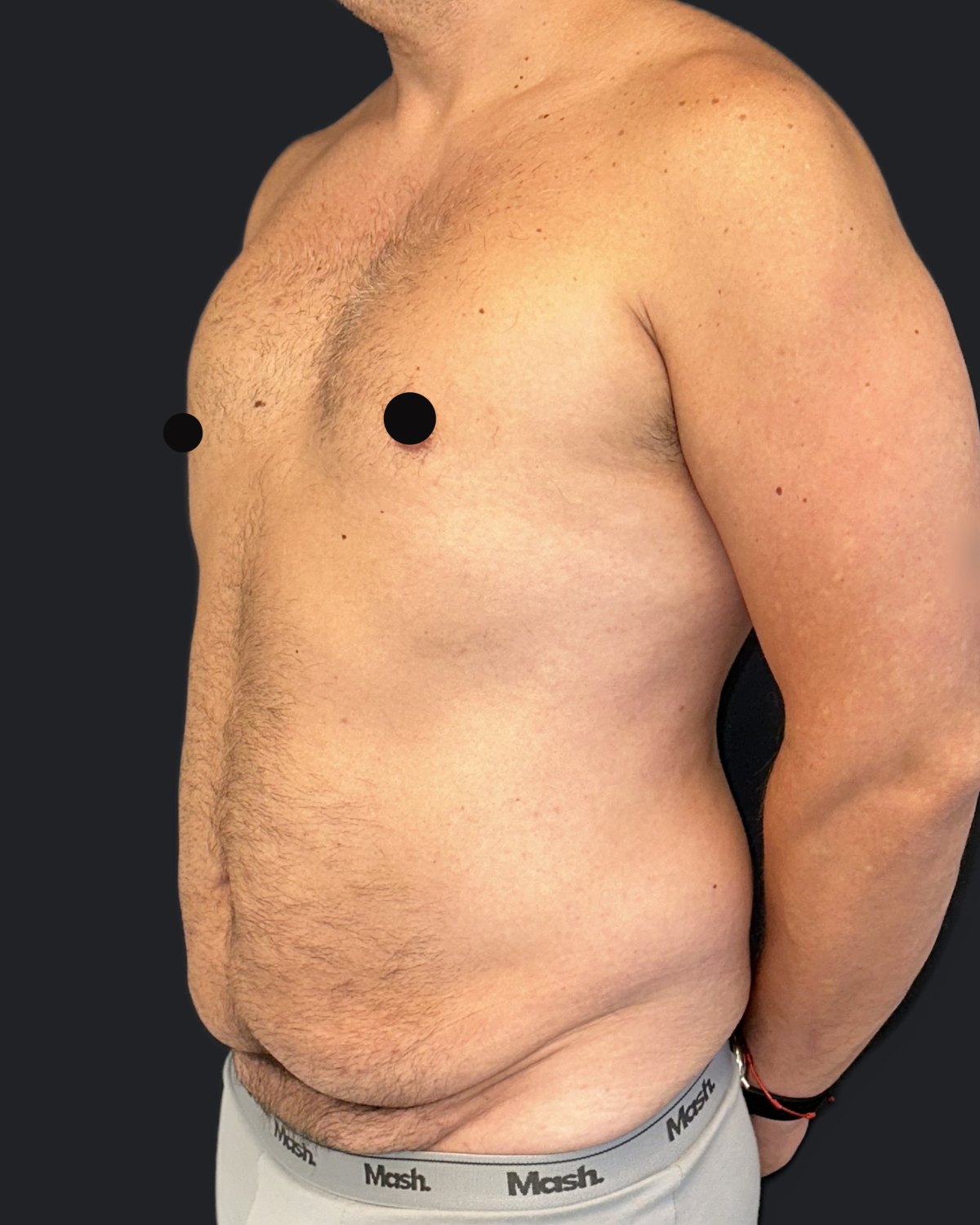 Antes — Abdominoplastia e lipoaspiração