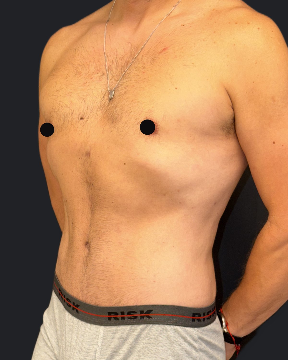 Depois — Abdominoplastia e lipoaspiração