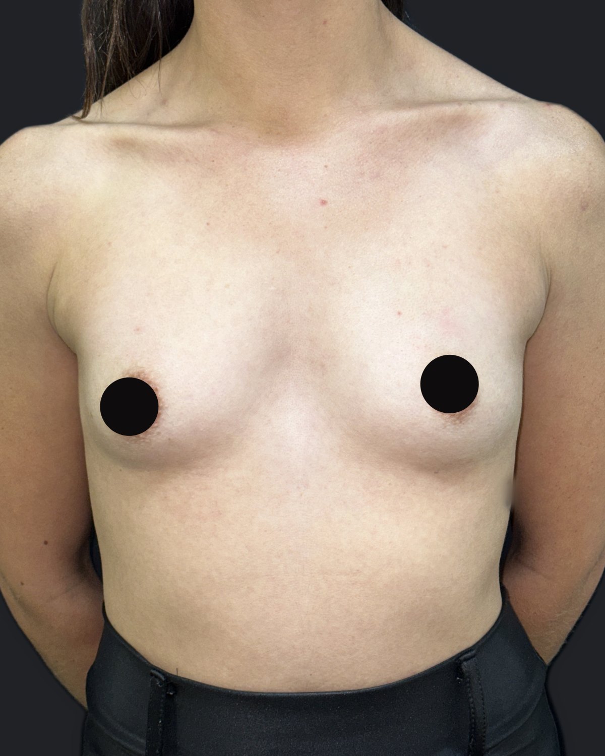 Antes — Prótese de mama — mamoplastia de aumento
