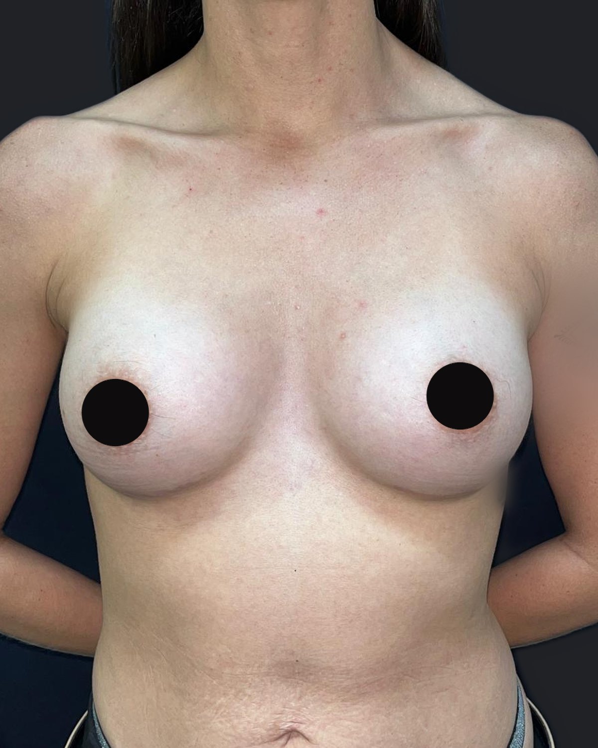 Depois — Prótese de mama — mamoplastia de aumento